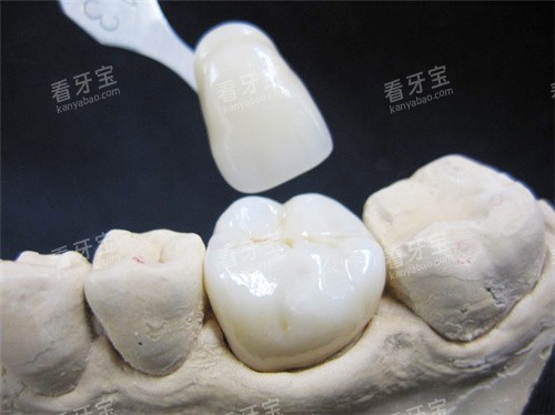lava全瓷牙.jpg lava全瓷牙.jpg