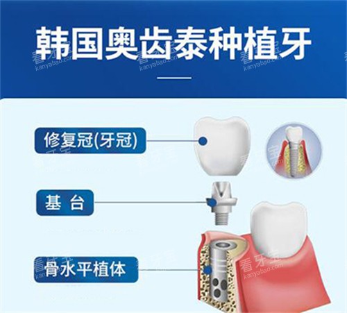 奥齿泰种植体材料图.jpg 奥齿泰种植体材料图.jpg