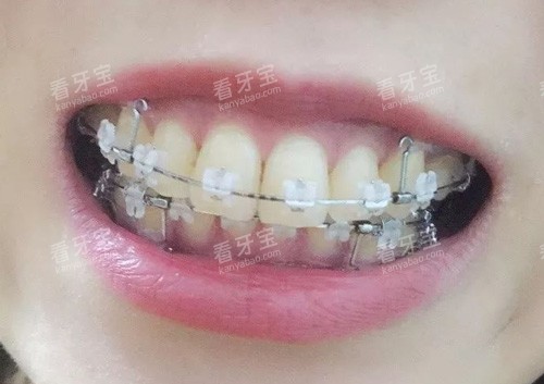 半隐形矫正细节图片.jpg 半隐形矫正细节图片.jpg