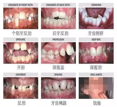 牙齿矫正不同类型的适应症.jpg 牙齿矫正不同类型的适应症.jpg