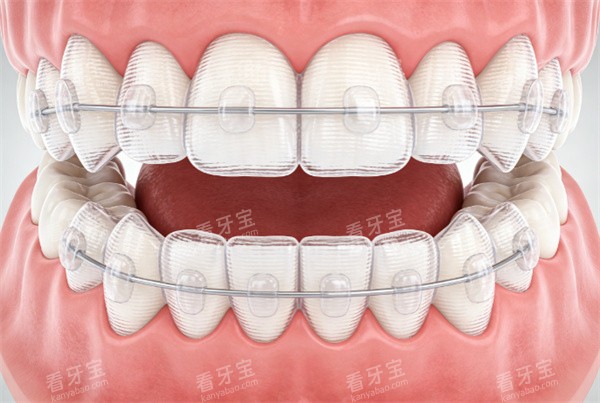 牙齿矫正动画卡通展示.jpg 牙齿矫正动画卡通展示.jpg