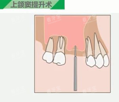 上颌窦提升步骤 上颌窦提升步骤