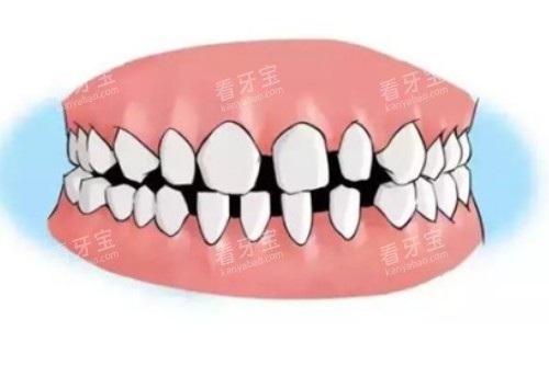 牙缝大卡通图.jpg 牙缝大卡通图.jpg