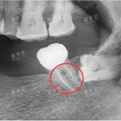 根管治疗后的牙齿.jpg 根管治疗后的牙齿.jpg