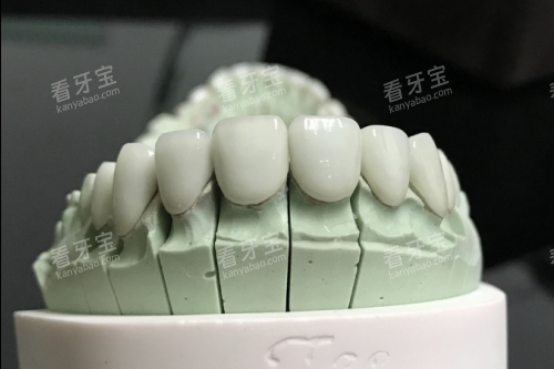 全瓷牙模型展示图.png 全瓷牙模型展示图.png
