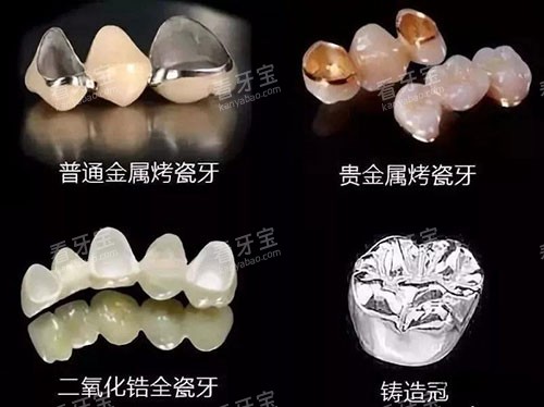 烤瓷牙的不同材质.jpg 烤瓷牙的不同材质.jpg
