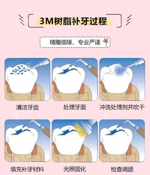 3M树脂补牙方法.jpg 3M树脂补牙方法.jpg