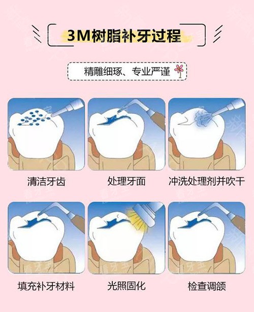 3M树脂补牙过程.jpg 3M树脂补牙过程.jpg