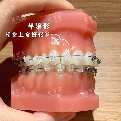 牙齿矫正陶瓷自锁托槽模型.jpg 牙齿矫正陶瓷自锁托槽模型.jpg