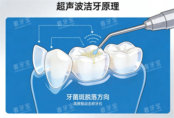 超声波洁牙原理示意图.jpg 超声波洁牙原理示意图.jpg