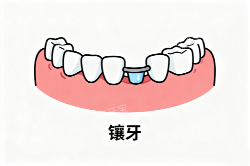 镶牙卡通图一览.png 镶牙卡通图一览.png