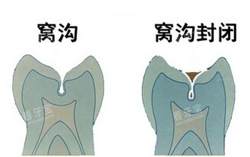 窝沟及窝沟封闭示意图.jpg 窝沟及窝沟封闭示意图.jpg