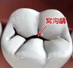 乳牙窝沟封闭.jpg 乳牙窝沟封闭.jpg