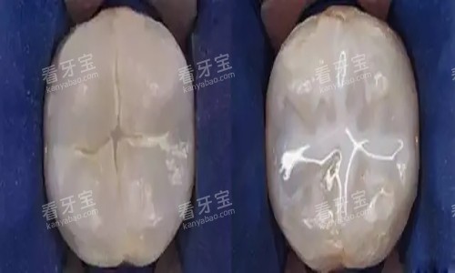 牙齿窝沟封闭卡通示意图.jpg 牙齿窝沟封闭卡通示意图.jpg