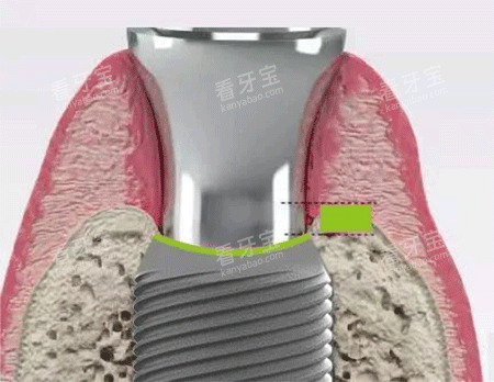 科惠微锥种植体照片.png 科惠微锥种植体照片.png