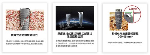 卡尔斯种植牙有什么不同.jpg 卡尔斯种植牙有什么不同.jpg