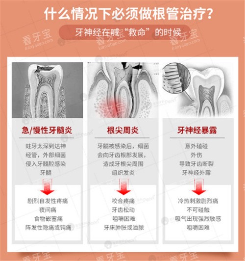 适合做根管治疗的情况.jpg 适合做根管治疗的情况.jpg