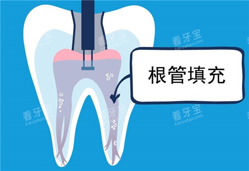 根管填充图示.jpg 根管填充图示.jpg