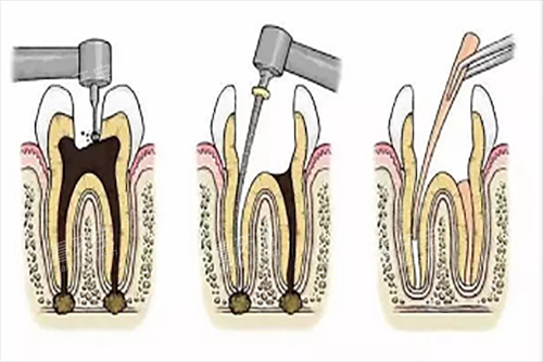 根管治疗步骤1.jpg 根管治疗步骤1.jpg