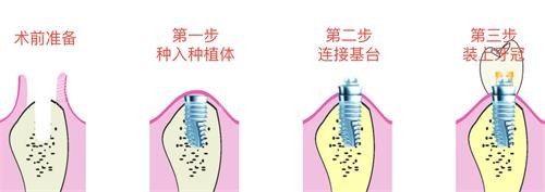 种植牙的步骤.jpg 种植牙的步骤.jpg