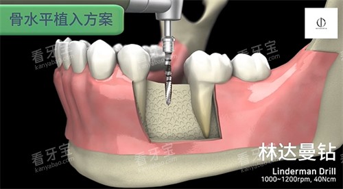 韩一种植体植入步骤.jpg 韩一种植体植入步骤.jpg