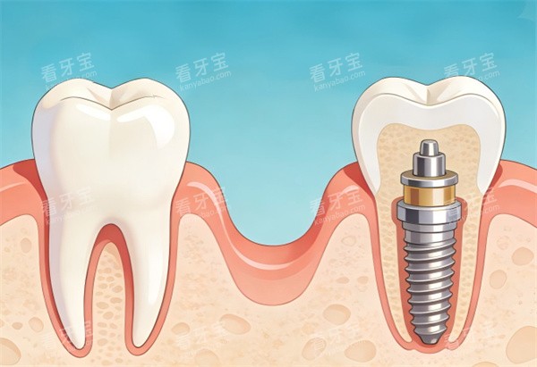 单颗种植牙卡通图片示意图.jpg 单颗种植牙卡通图片示意图.jpg