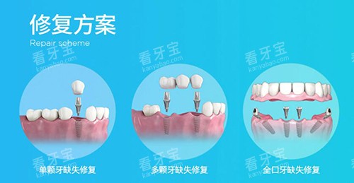 zdi种植体改善展示.jpg zdi种植体改善展示.jpg