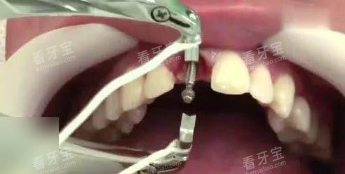 种植体手术细节图.jpg 种植体手术细节图.jpg