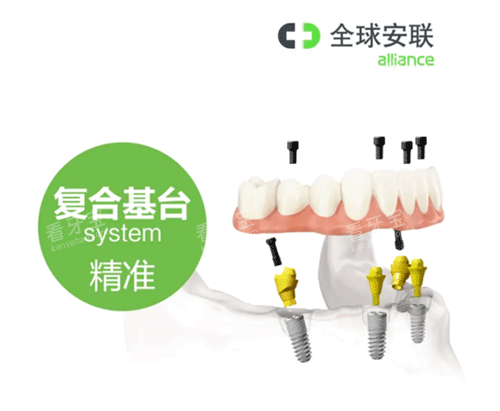 安联种植牙复合基台照片.png 安联种植牙复合基台照片.png