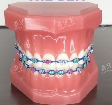 牙齿矫正牙套模型示意图.jpg 牙齿矫正牙套模型示意图.jpg