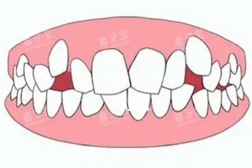 牙列拥挤模型图.jpg 牙列拥挤模型图.jpg