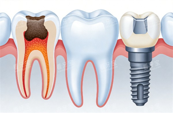 牙齿种植治疗卡通示意图.jpg 牙齿种植治疗卡通示意图.jpg