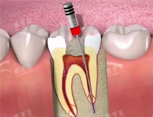 根管治疗动画模拟图.jpg 根管治疗动画模拟图.jpg