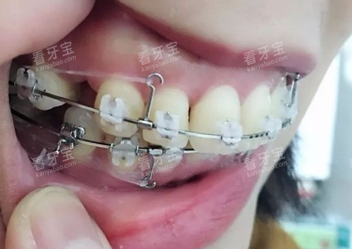 半隐形矫正细节图.jpg 半隐形矫正细节图.jpg