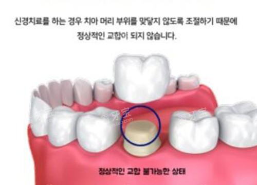 牙冠修复改善过程.jpg 牙冠修复改善过程.jpg
