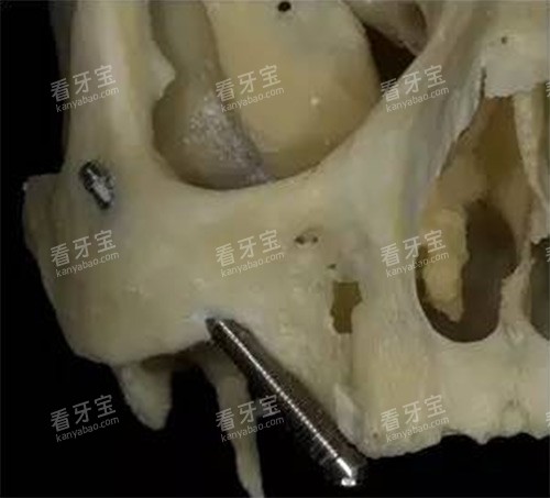 穿颧穿翼种植过程.jpg 穿颧穿翼种植过程.jpg