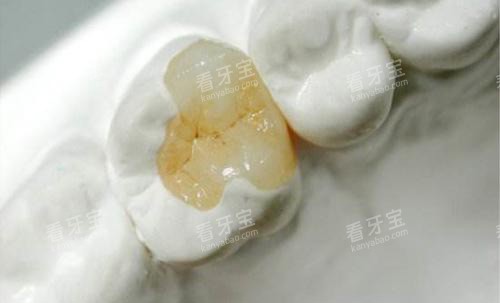 嵌体补牙后展示图 嵌体补牙后展示图