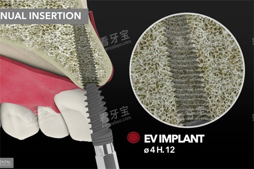 意大利BB种植牙上颌种植.jpg 意大利BB种植牙上颌种植.jpg