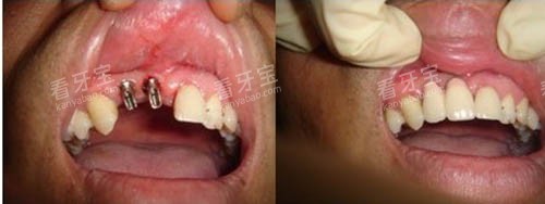 种牙前后照片.jpg 种牙前后照片.jpg