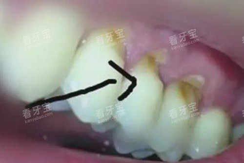 牙齿楔状缺损实拍图.jpg 牙齿楔状缺损实拍图.jpg