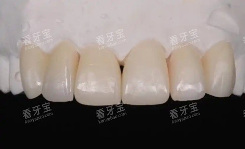 爱迪特全瓷牙示意图.jpg 爱迪特全瓷牙示意图.jpg