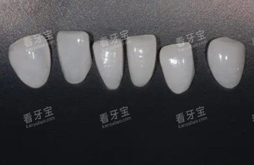 牙齿贴面修复改善.jpg 牙齿贴面修复改善.jpg