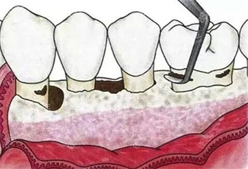 牙周翻瓣手术卡通图.jpg 牙周翻瓣手术卡通图.jpg