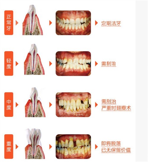 牙周病治疗流程.jpg 牙周病治疗流程.jpg