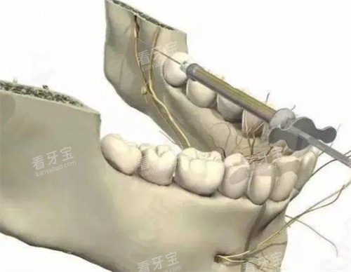 牙周内注射麻醉的入针点.jpg 牙周内注射麻醉的入针点.jpg