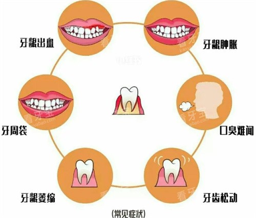 牙周疾病照片.jpg 牙周疾病照片.jpg