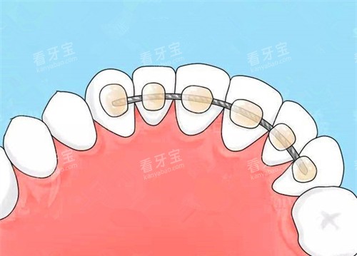牙齿矫正舌侧保持器.jpg 牙齿矫正舌侧保持器.jpg