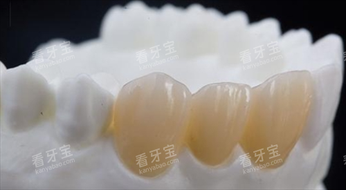 前牙全瓷冠展示.png 前牙全瓷冠展示.png