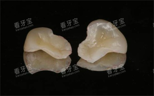 树脂嵌体实物展示图.jpg 树脂嵌体实物展示图.jpg