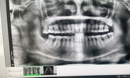 临沂德贝口腔拍摄的牙片.jpg 临沂德贝口腔拍摄的牙片.jpg